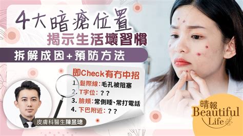 上唇 暗瘡|9大暗瘡位置：下巴暗瘡=腎虧？中醫去暗瘡有用嗎？